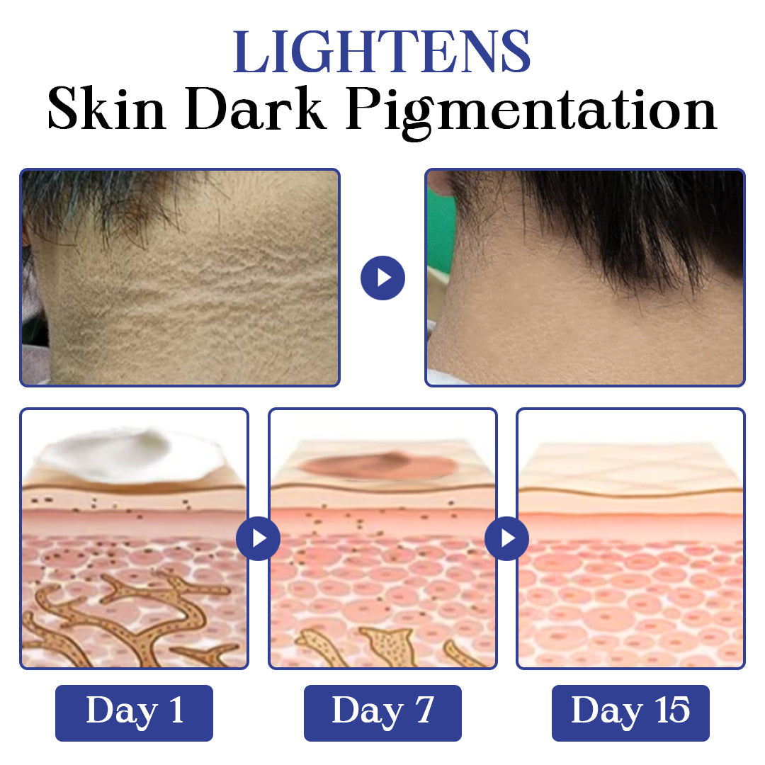 Kisshi™ Back Spots & Acanthosis Nigricans